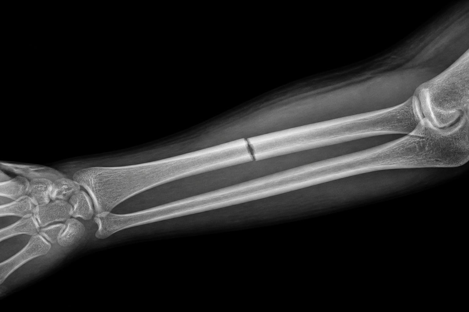 Röntgenaufnahme einer Hand